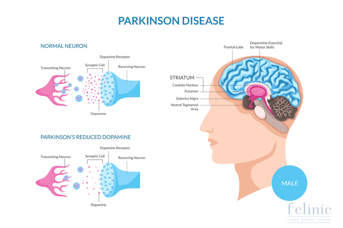 Điều trị Parkinson bằng tế bào gốc